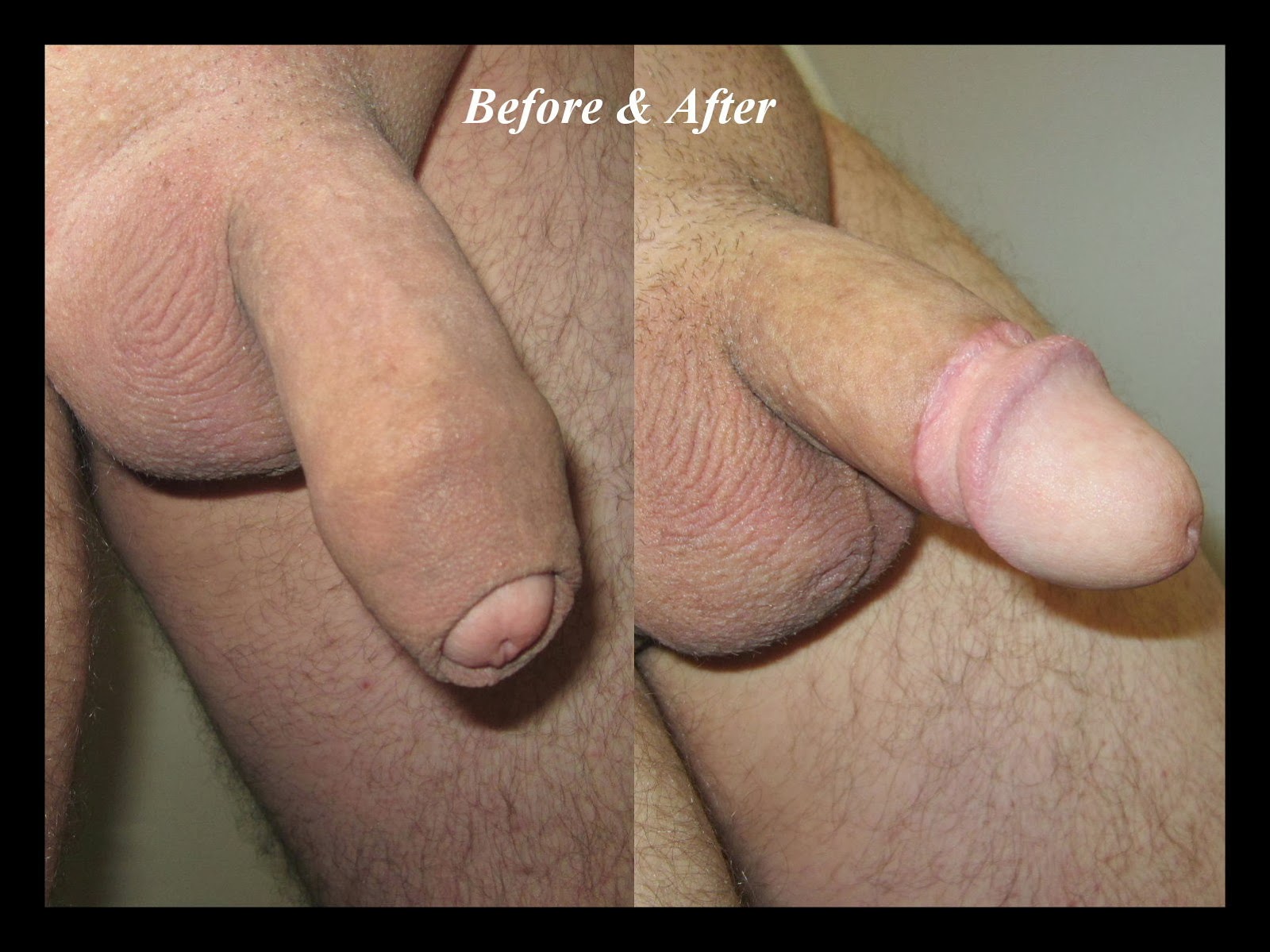 Images of uncircumcised - 🧡 File:Circumcised and uncircumcised penis.jpg -...